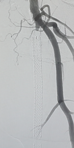 Case 2 — pre-procedure angiogram showing arterial occlusion